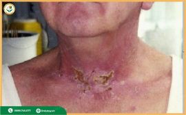 Lở Loét Da Sau Xạ Trị: Nguyên Nhân, Đối Tượng Nguy Cơ Và Giải Pháp Khắc Phục An Toàn