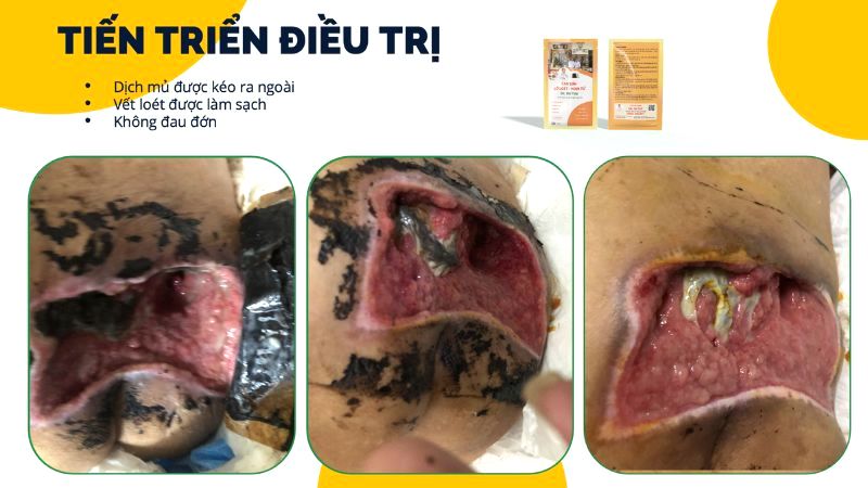 phuong-phap-ho-tro-dieu-tri-loet-ti-de(1)