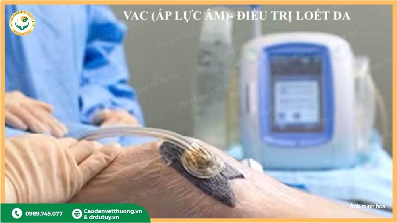 phuong-phap-vac-dieu-tri-vet-thuong-ap-luc-am