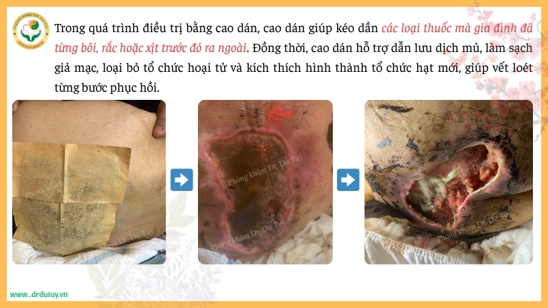 quá trình điều trị loét da bằng cao dán