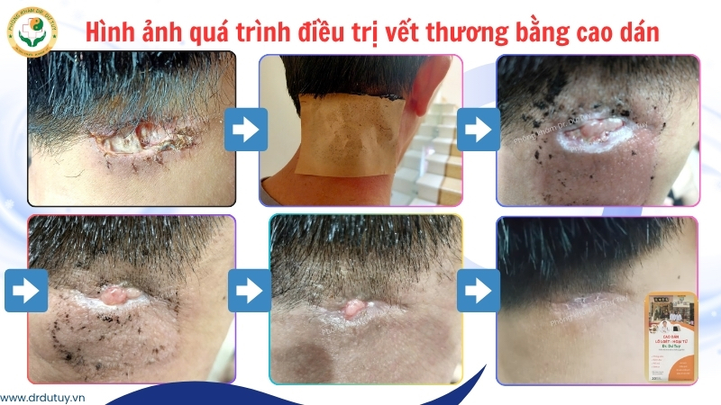 qua-trinh-dieu-tri-vet-thuong-bang-cao-dan(1)