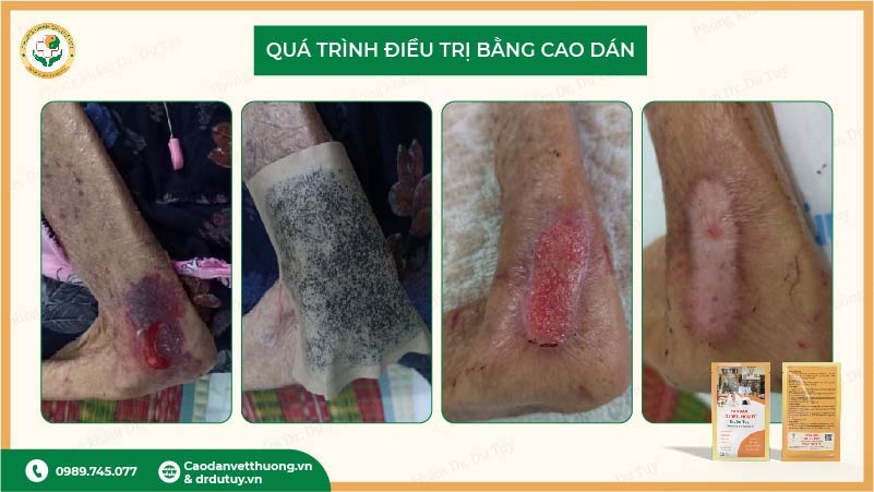 qua-trinh-dieu-tri-vet-thuong-bang-cao-dan