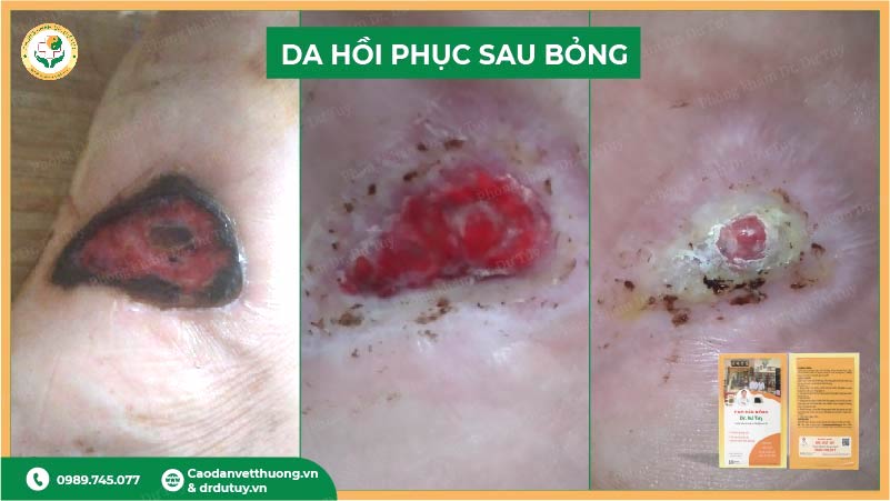 qua-trinh-hoi-phuc-vet-bong
