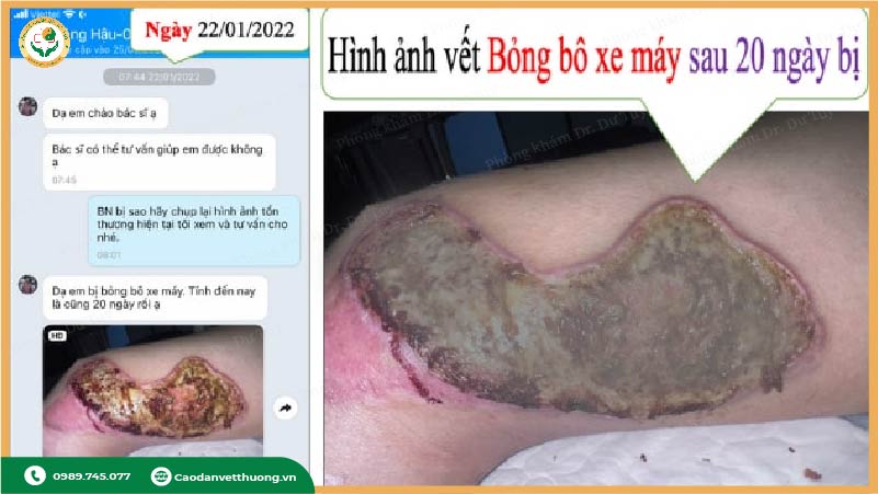 qua-trinh-lanh-vet-bong