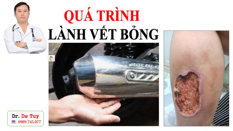 qua-trinh-lanh-vet-bong_thumb1
