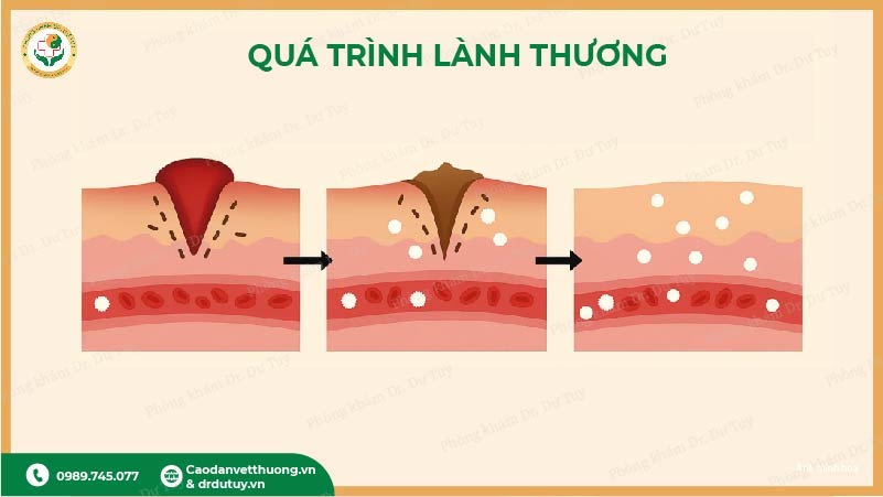 qua-trinh-lanh-vet-loet-ngoai-da