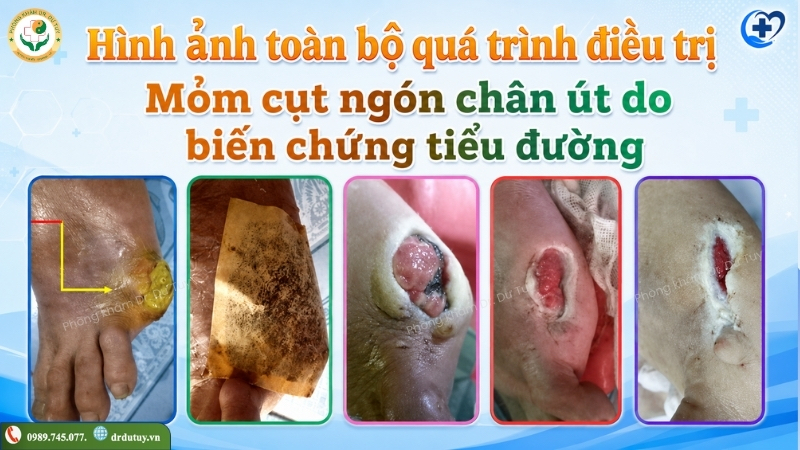 qua-trinh-phuc-hoi-mom-cut-ngon-chan-ut