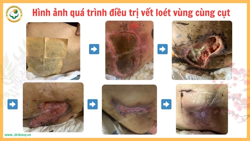 quá trình phục hồi vết loét vùng cùng cụt