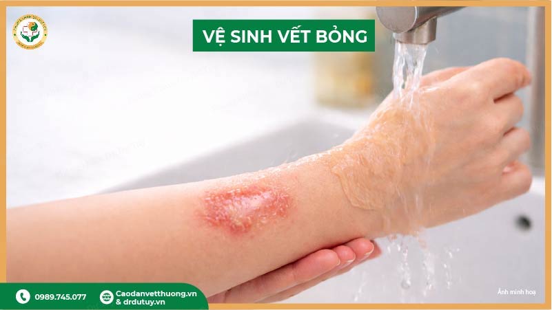 rửa vết bỏng đúng cách
