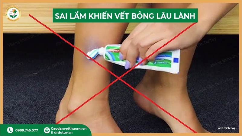 sai lầm bôi kem đánh răng vết bỏng