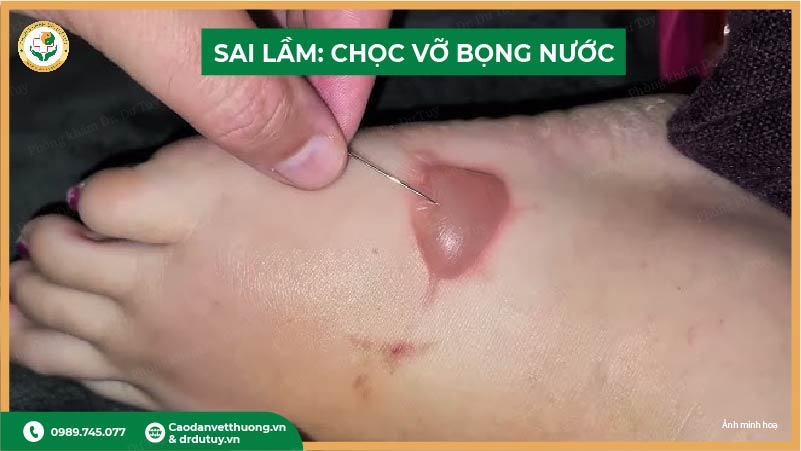 sai lầm chọc vỡ bọng nước khi bị bỏng