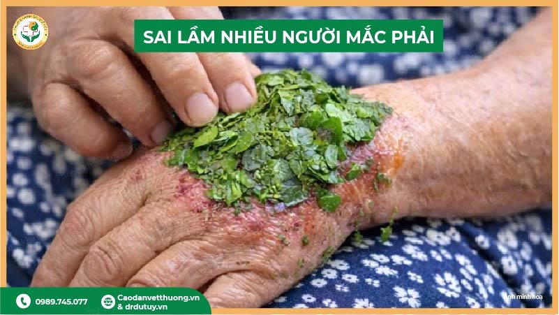 sai lầm khi chữa bỏng đắp lá