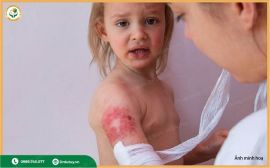 Bỏng Ở Trẻ Em: Hướng Dẫn Xử Lý ĐÚNG CÁCH Để Bé Không Đau Xót Và Giảm Hoảng Sợ