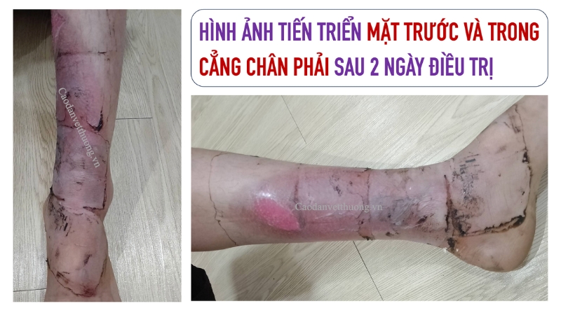 Sơ cứu khi bị bỏng nước sôi