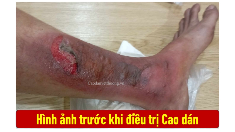 Sơ cứu khi bị bỏng