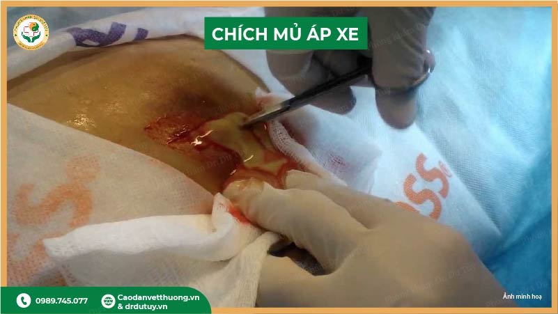 so-sanh-cao-dan-va-chich-mu-nen-chon-phuong-phap-nao-khi-bi-ap-xe