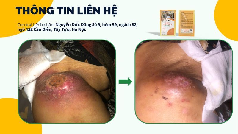 so-sanh-truoc-sau-dieu-tri-loet