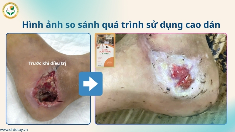 so-sanh-vet-thuong-got-chan-truoc-va-sau-khi-dung-cao-dan