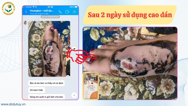 so-sanh-vet-thuong-truoc-va-sau-2-ngay-dung-cao-dan