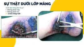 Cảnh báo: Vết thương nhiễm trùng nặng vì thói quen tự ý dùng thuốc xịt và bột rắc