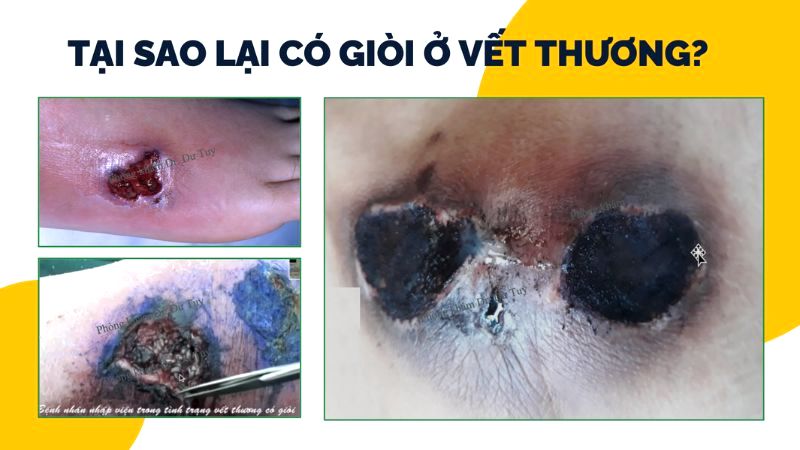 tai-sao-lai-co-gioi-trong-vet-thuong