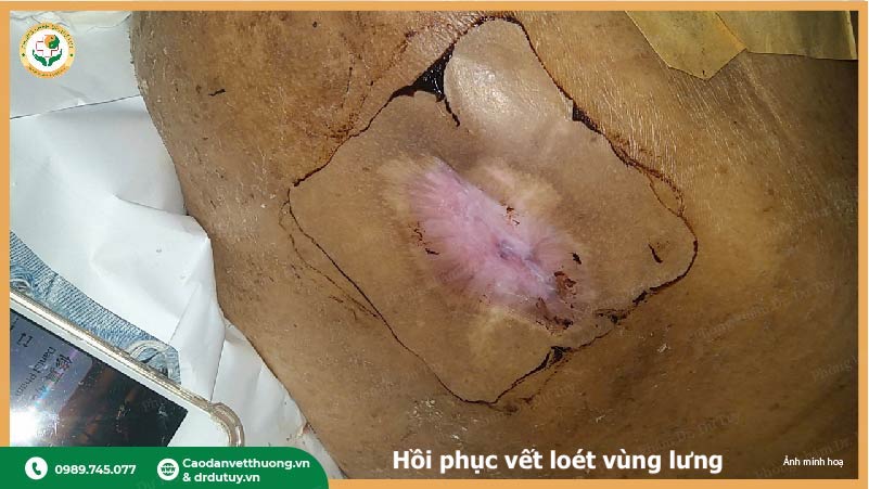 tai-tao-da-sau-vet-loet