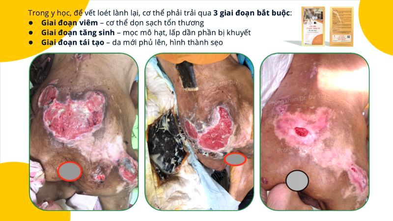 tam-ly-nong-voi-khi-dieu-tri-vet-loet-lon