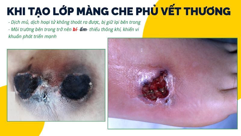 tao-lop-mang-che-phu-vet-thuong-bi-am-vi-khuan