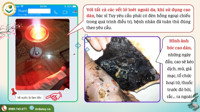 theo-doi-vet-loet-ban-chan-khi-thay-cao-dan(1)