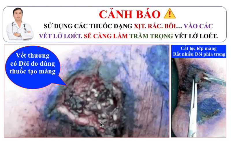 Thuốc bôi loét tỳ đè