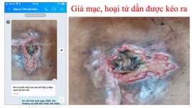 Thuốc chữa loét cùng cụt 