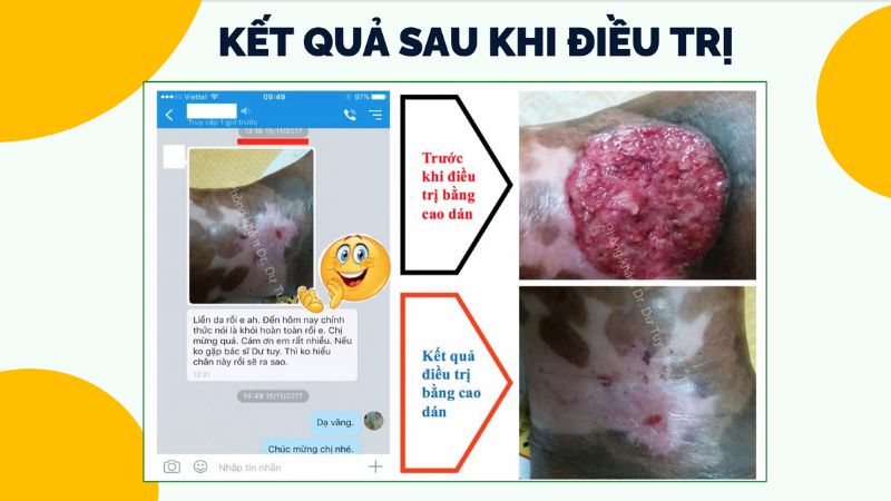 thuốc trị loét chân