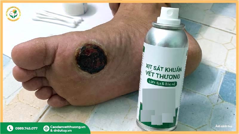 thuoc-xit-sat-khuan-vet-thuong