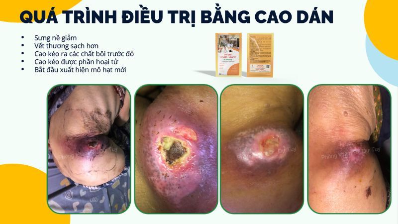 tien-trien-dieu-tri-loet-ty-de