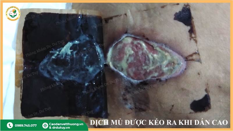 tien-trien-lo-loet-sau-khi-dan-cao-thao-duoc