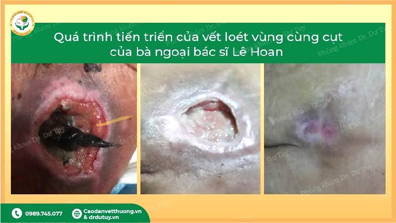 tien-trien-lo-loet-vung-hong-sau-dan-cao