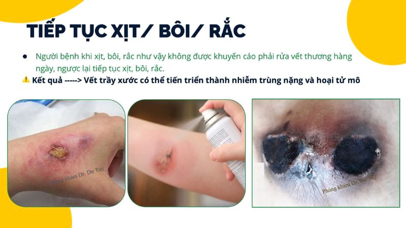 tiep-tuc-xit-boi-rac-vet-thuong-nguy-co-nhiem-trung