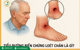 Tiểu đường bị loét chân