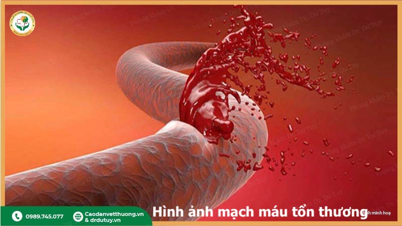 ton-thuong-mach-mau-do-tieu-duong