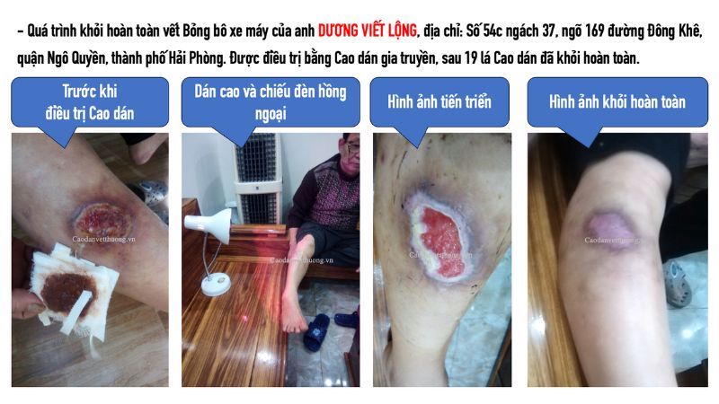 trước sau bỏng bô xe máy