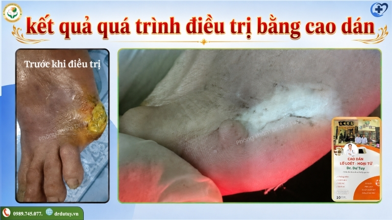 truoc-va-sau-cham-soc-mom-cut-ngon-chan