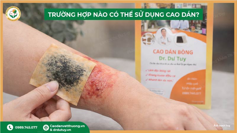 trường hợp nào có thể sử dụng cao dán trị bỏng