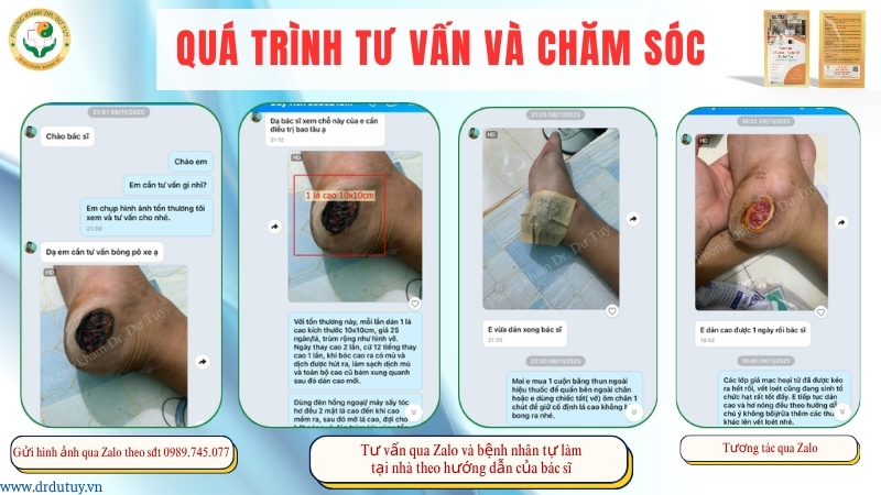 tu-van-cham-soc-vet-loet-qua-zalo-dr-du-tuy