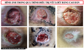 Chuyên điều trị loét da bằng cao dán Đông Y tại Bình Định