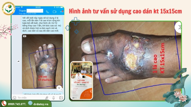 tu-van-kich-thuoc-cao-dan-loet-ban-chan