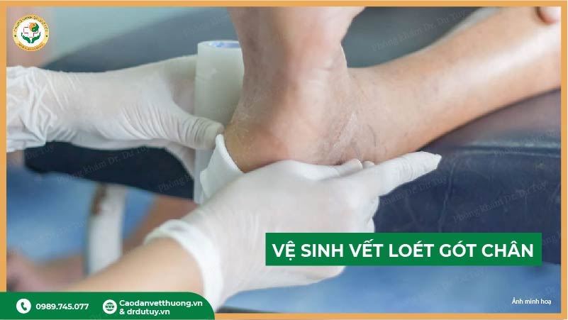 ve-sinh-vet-loet-got-chan