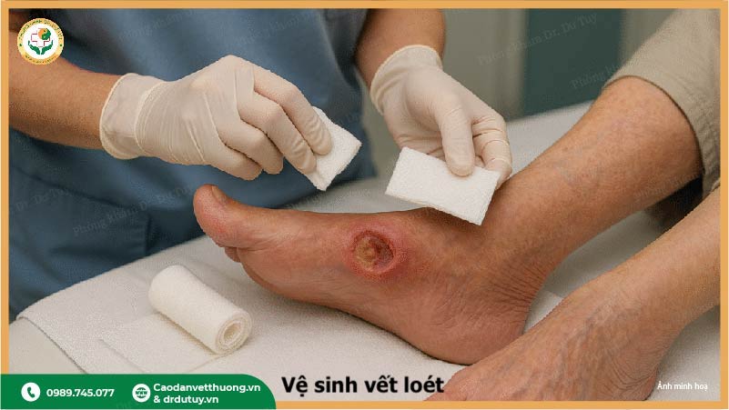 ve-sinh-vet-loet-ti-de
