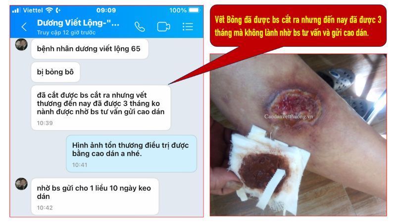 vết bỏng 3 tháng không lành