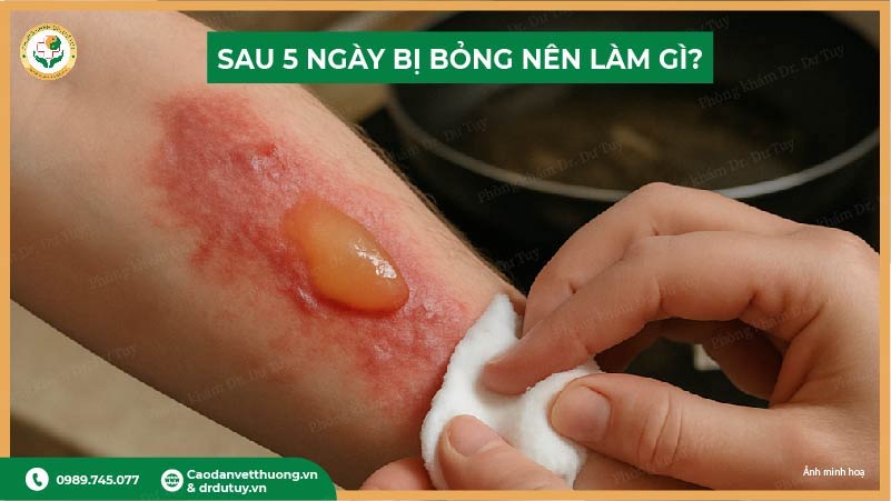 vết bỏng 5 ngày có bọng nước