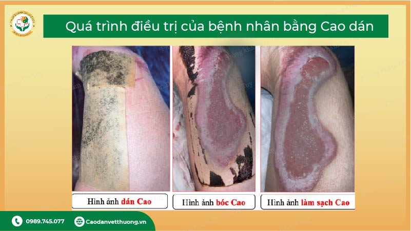 vet-bong-bao-lau-thi-lanh